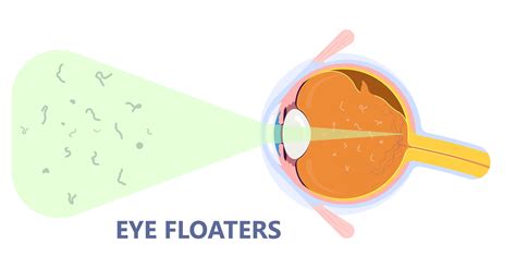 How To Cure Eye Floaters