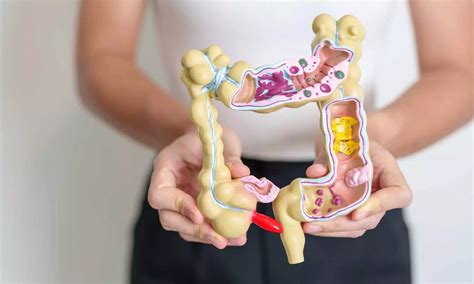 Colitis Vs. Cancer 的图像结果