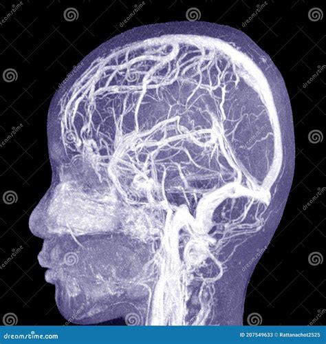 MRA BRAIN.Moderate Perilesional Vasogenic Edema with 0.7 Cm Midline Shift To the Left Side ...