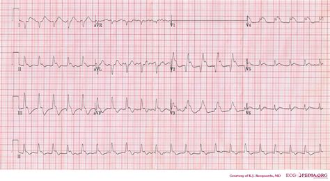 Pulmonary Embolism Ecg EKG Taken On A Patient With An Acute Pulmonary