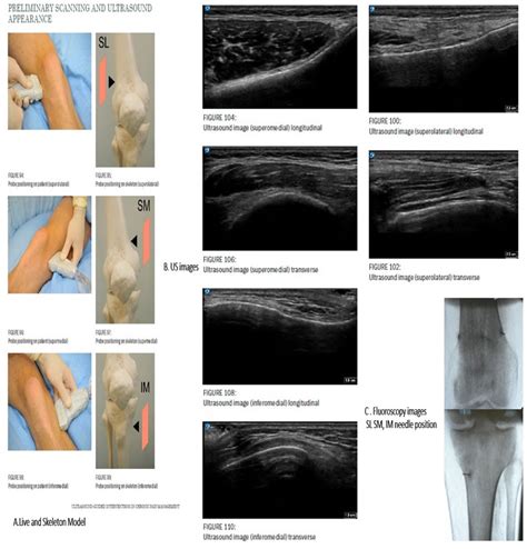 ESRA19-0635 Should we use genicular nerve block for pain control after ...