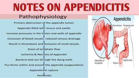 Image result for Appendix Variants