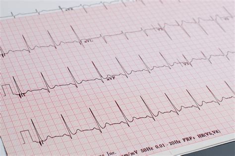 What is Borderline ECG? Meaning, Causes and Implications – Heart ...