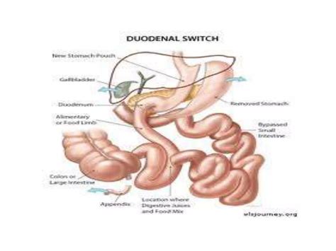 Duodenal switch surgery | PPTX | Surgery | Medical Health