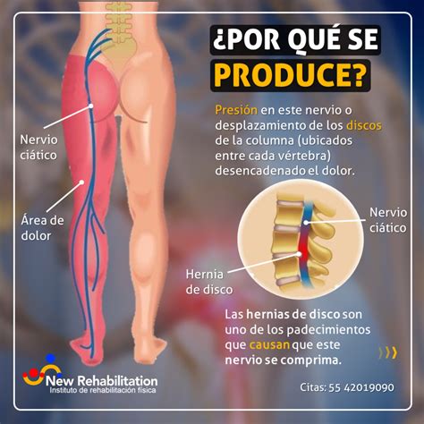 Hernia Lumbar Y Nervio Ciatico at Matthew Calzada blog