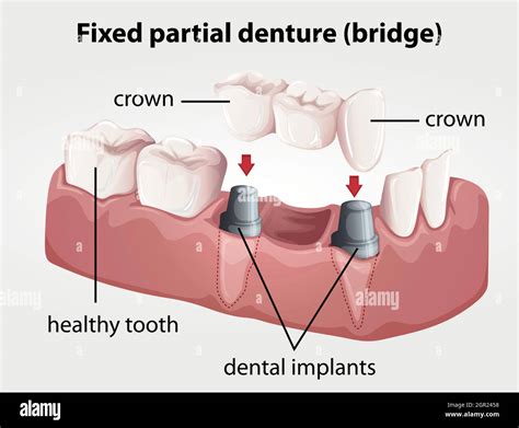 Dental procedure Stock Vector Images - Alamy