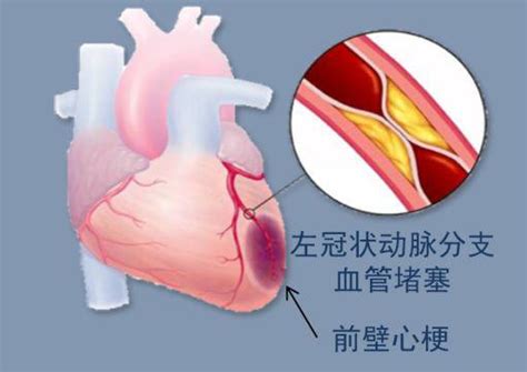 急性冠状动脉综合征为啥让人“痛”心棘手 - 上海科普网