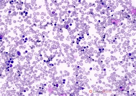Haemoglobin Bart's Hydrops Fetalis - LearnHaem | Haematology Made Simple