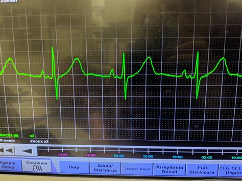 Is this a notched p-wave or something else? : r/nursing