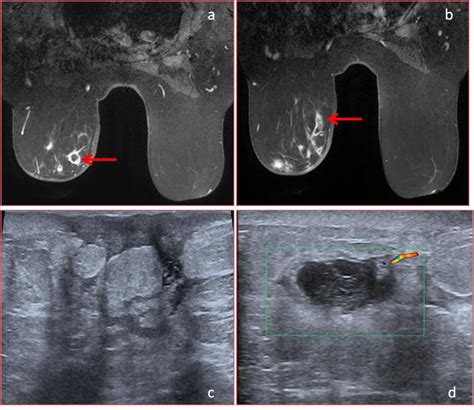 granulomatöse Mastitis | pacs