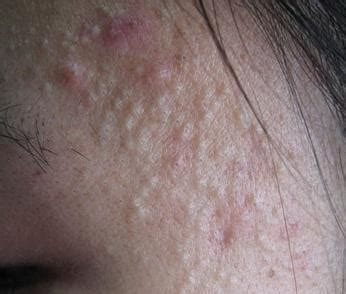 為什麼皮膚反覆過敏，長痘痘？ - 每日頭條