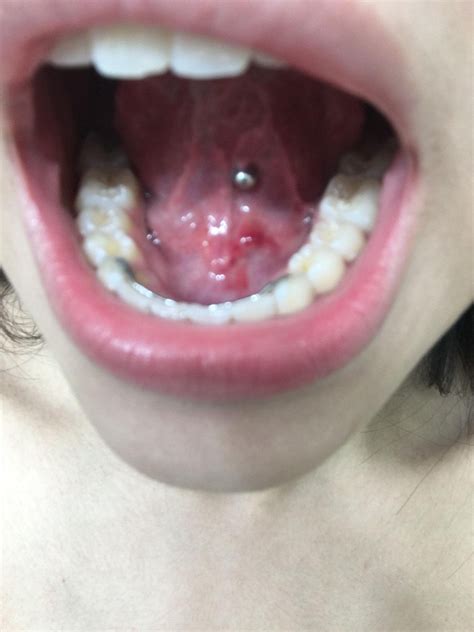 Red Bump Under Tongue