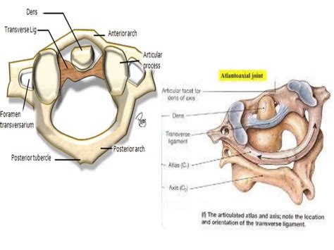 Imaging of atlanto occipital and atlantoaxial traumatic injuries | PPTX