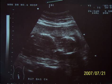怀孕2个月胎儿b超图_怀孕3个月胎儿b超图_怀孕6个月胎儿b超图_国际范文网