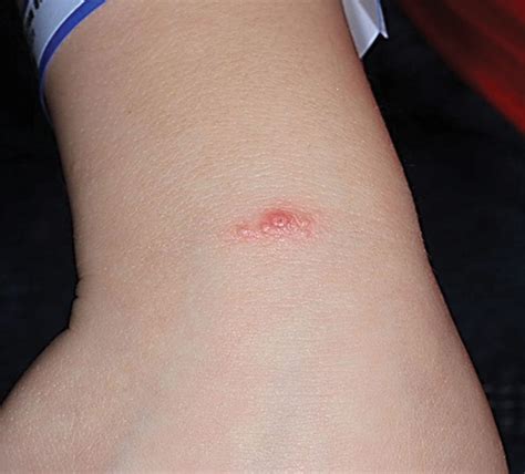 Can Ulcer Cause Swollen Lymph Nodes - Infoupdate.org