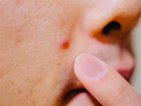 इलेक्ट्रोलिसिस म्हणजे काय? त्यासाठी तयारी कशी करावी? | How to Prepare ...