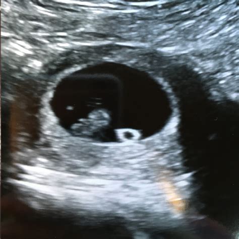 Confirmed Boy and Girl Ultrasound Scans - A Collection of Boy and Girl ...