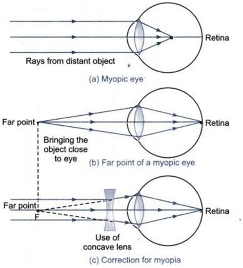 what is miopia? state the two causes of myopia with the help of ray ...