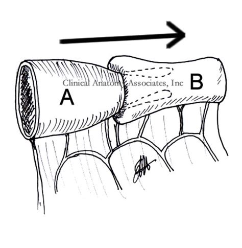 Image result for Intussusception Symptoms