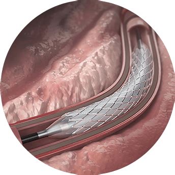 Medzus | Vascular Access Implant Testing