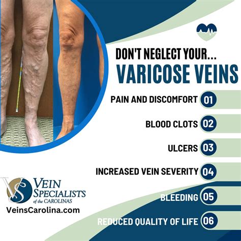 Why Is It Important to Treat Your Varicose Veins? - Vein Specialists of the Carolinas