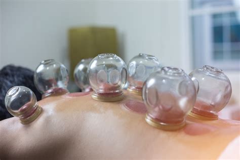 Cupping Therapy - Katie Gaffney, OMD, L.Ac.