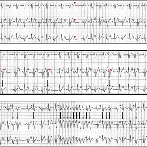 Image result for Telemetry Practice