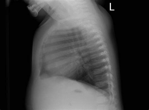 Normal Lateral Chest Xray Normal chest x-ray | Radiology Case ...