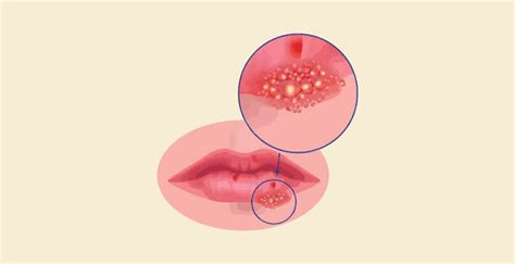 Difference Between Scabies and Herpes – Knya