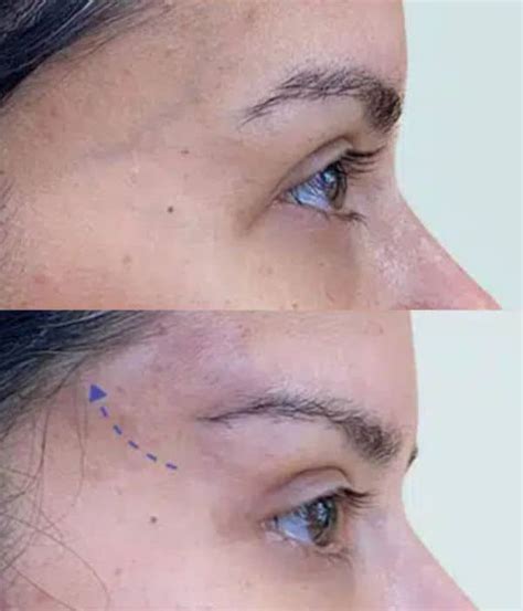 Image result for Fox Eye Thread Lift Procedure