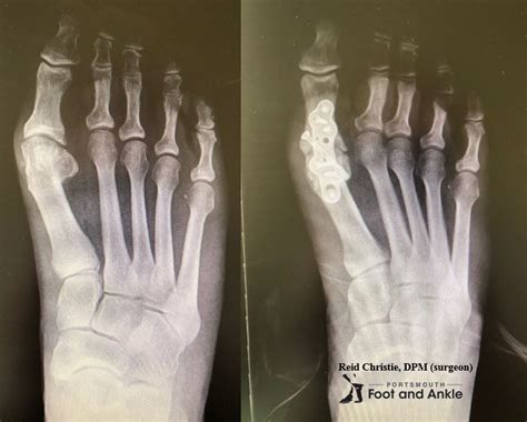 Arthritis in the Big Toe | Arthritis in big toe, Arthritis, Big toe