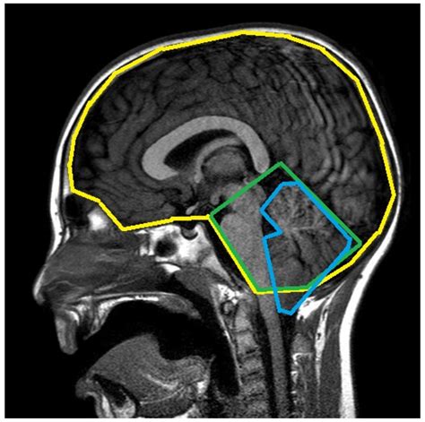 A Machine Learning Approach to Support Treatment Identification for Chiari I Malformation