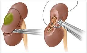 Image result for Hal Nephrectomy