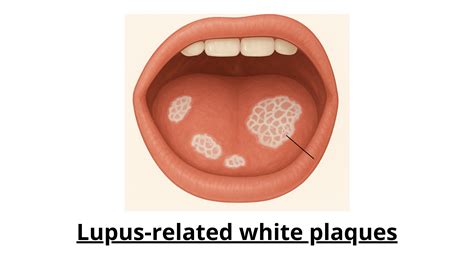 How Do Lupus Mouth Sores Look? A Complete Visual Guide