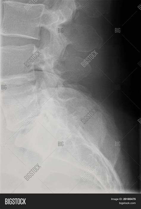 Lateral Coccyx Xray