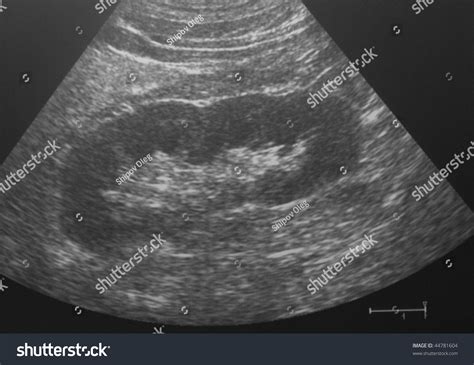 Kidney Anatomy Ultrasound
