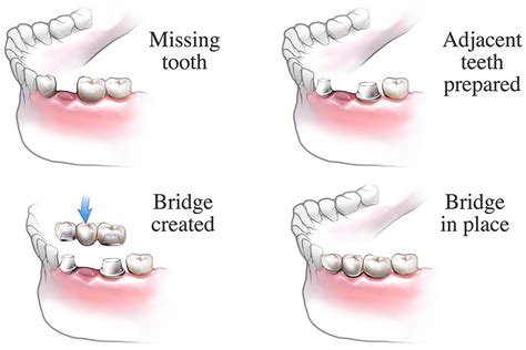 Homemade Dental Bridge 的图像结果