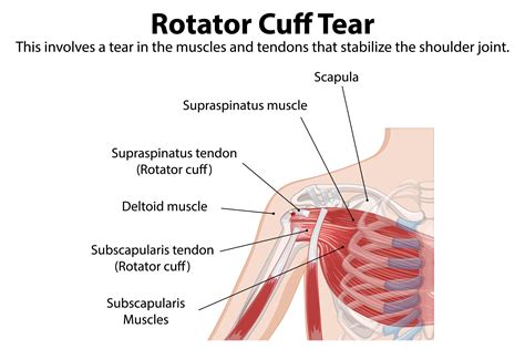 Rotator Cuff Tear - The Physio Approach