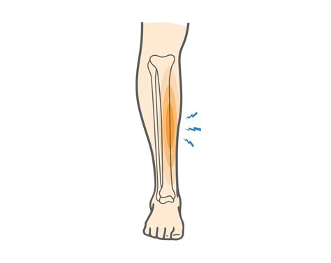Leg Contusion (Bruise): Causes, Symptoms & Treatment - Upswing Health