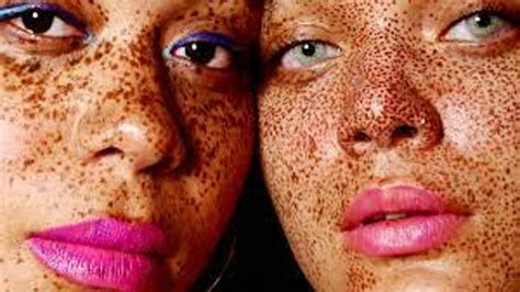 International Skin Pigmentation Day 2023: Dates, History and Significance