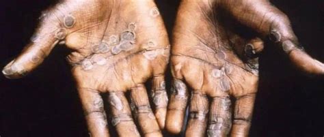 猴痘已传至中东，以色列出现首例感染病例_专家称猴痘已在英国普通人中传播_病毒_西非