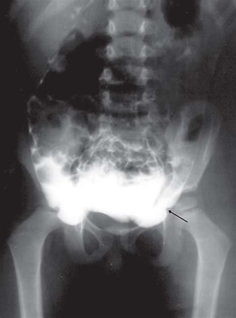 Image result for Peritoneum Injection