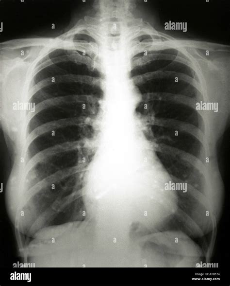 Normal chest x ray Stock Photo - Alamy