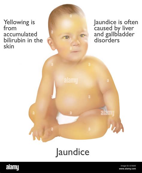 Yellow Skin Jaundice