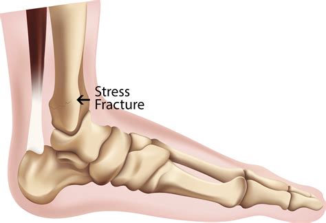 Stress Fracture On Foot Healing Time Sale | emergencydentistry.com