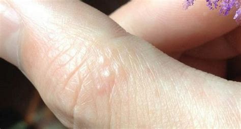 手指突然出現這種小水泡，是某些病的前兆 - 每日頭條