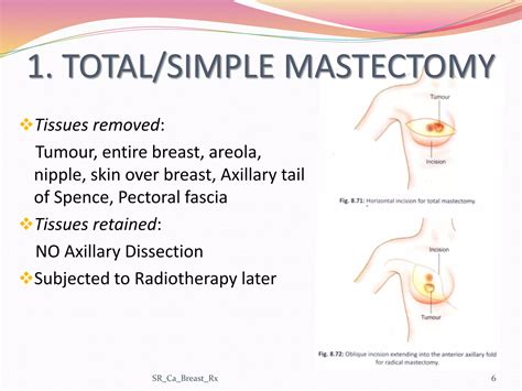 MANAGEMENT OF BREAST CARCINOMA | PDF