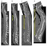 Associations between Clinical Findings and Severity of Diffuse ...