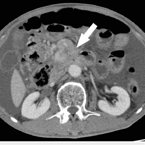 Image result for CT Scan with Contrast