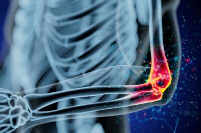 Image result for Elbow Cysts Explode